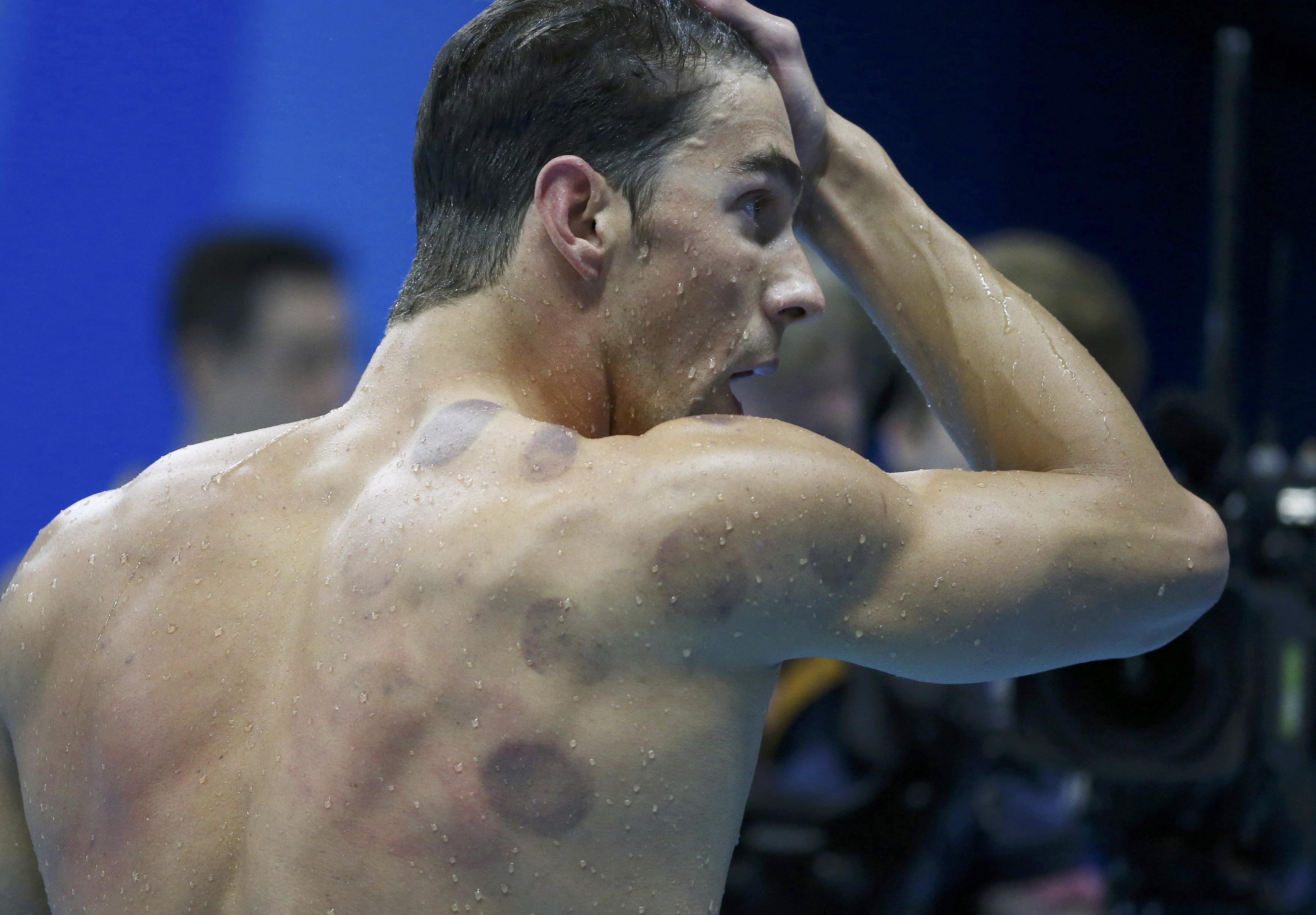 u-s-swimming-star-phelps-gives-cupping-a-boost-in-china-the-japan-times