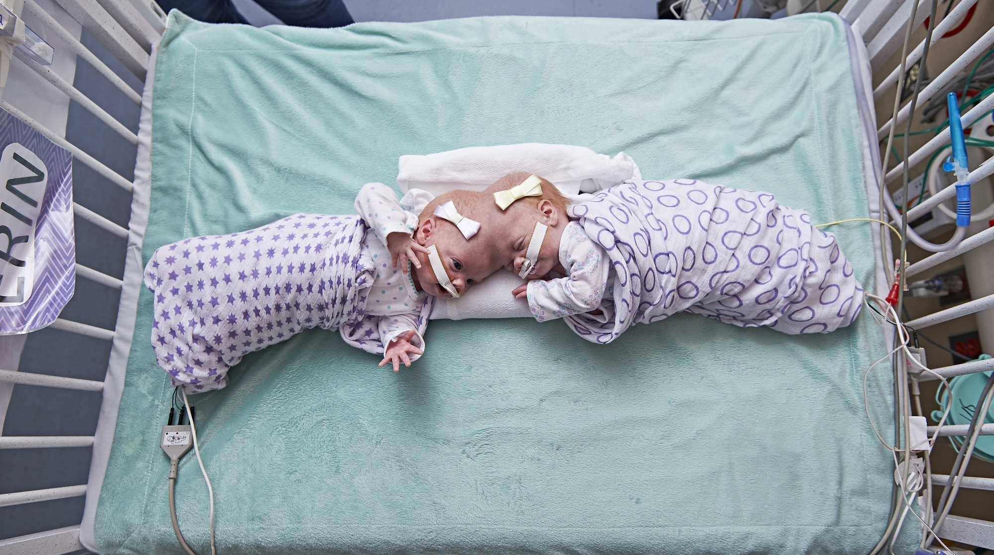 In 11 Hour Surgery Philadelphia Hospital Separates 10 Month Old Twins Conjoined At Their Heads