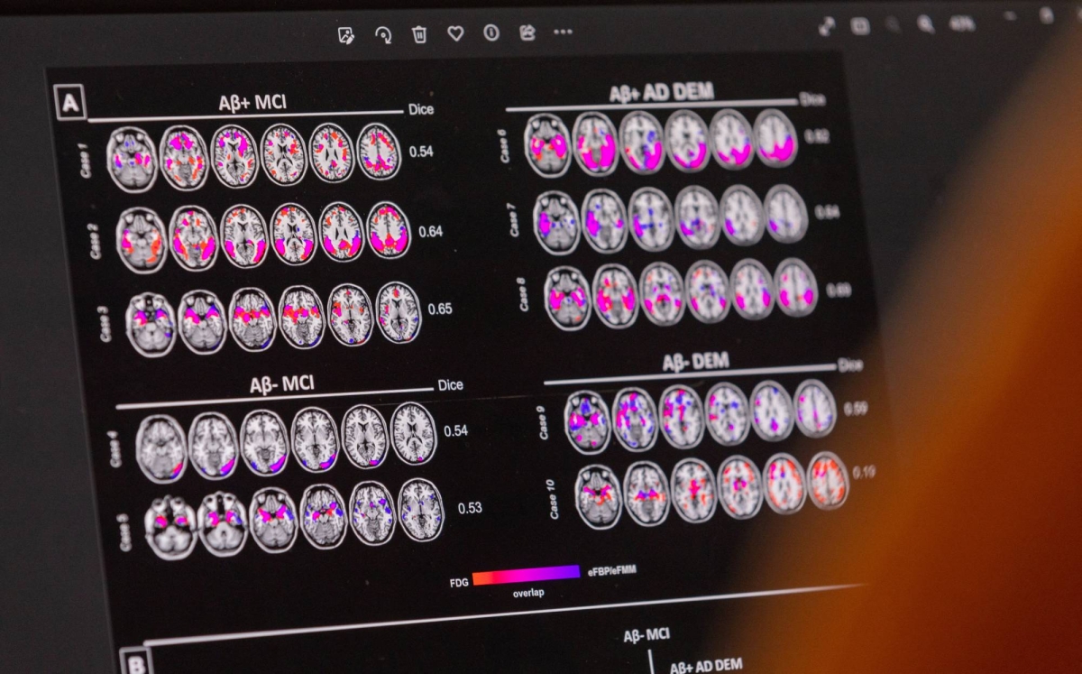 Revolution or mirage? Controversy surrounds new Alzheimer’s medicine